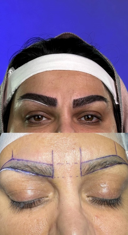 کاشت ابرو چیست؟