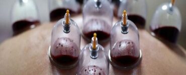 حجامت توسط افراد غیر متخصص خطرناک است